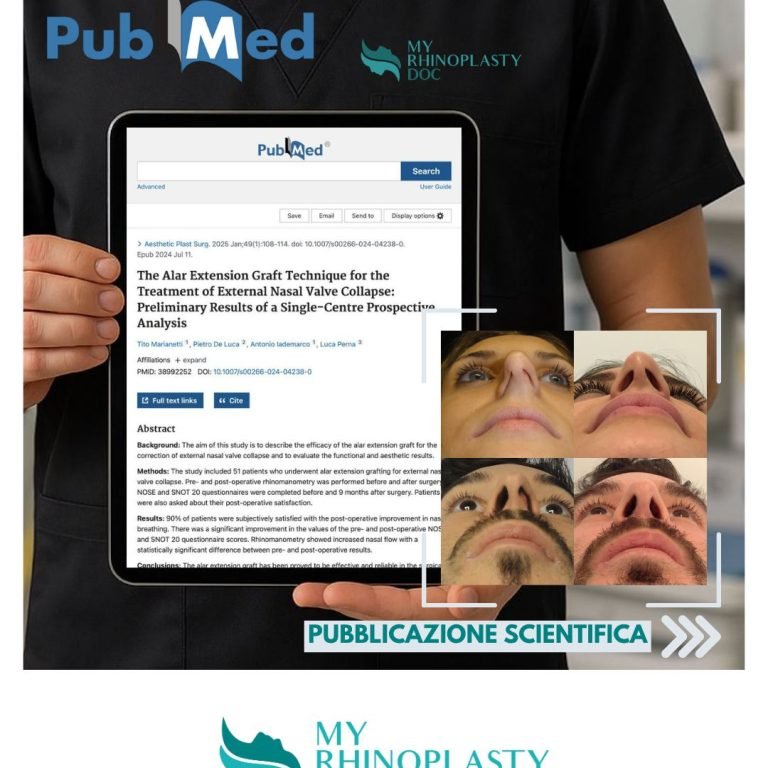 Alar Extension Graft - un nuovo passo avanti firmato MyRhinoPlastyDoc