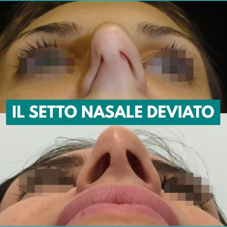 setto-deviato